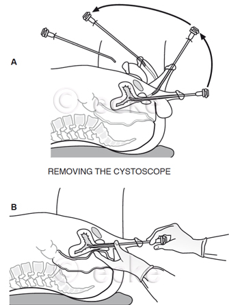 Cystoscope